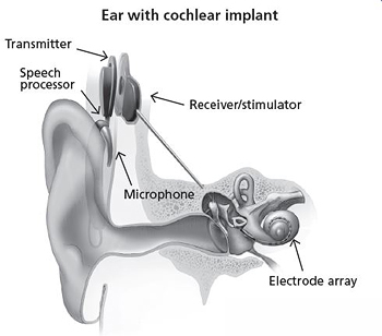 ear with cochlear implant